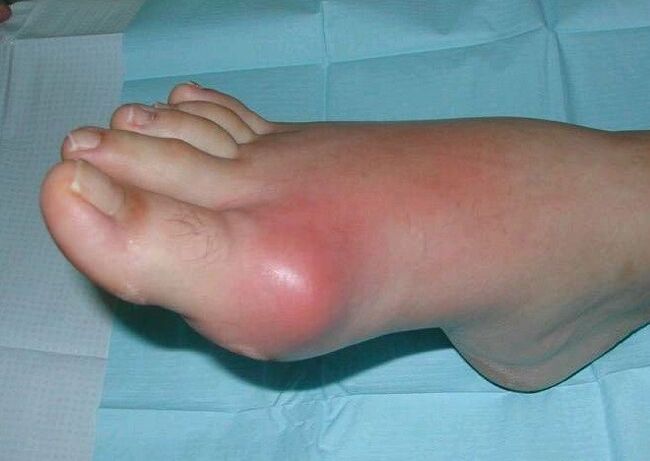 Jalaliigese artriidi kliiniline pilt - turse ja põletik