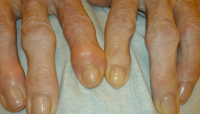valu sõrmede liigestes osteoartriidiga