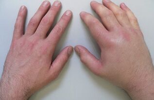 artralgia kui valu põhjus sõrmede liigestes