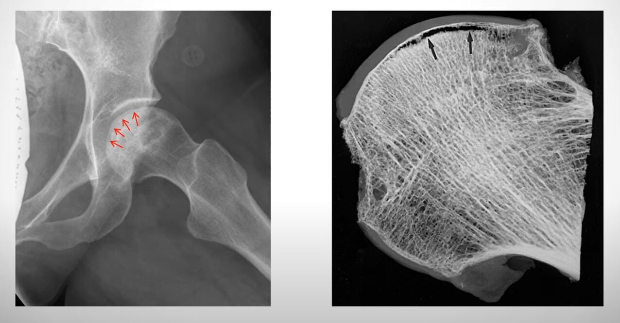 Aseptilise nekroosiga mõjutatud reieluupea röntgenuuring